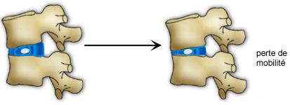 Perte de mobilité au niveau des vertèbres