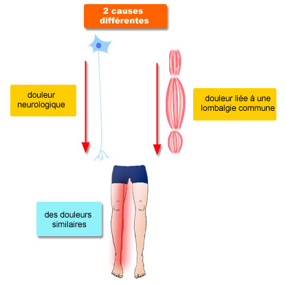 Diffusion douleur neurologique et douleur liée à une lombalgie commune