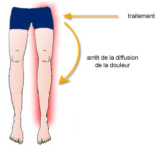 Lombalgie : comprendre la douleur des membres inférieurs