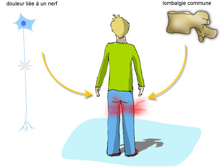Douleur liée à un nerf