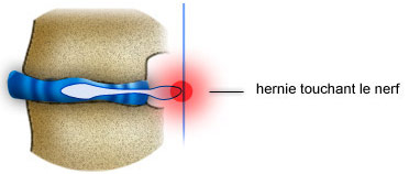 hernie hernie