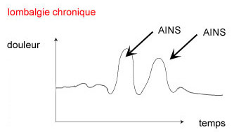 Douleur de la lombalgie chronique