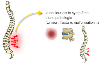 La douleur lombaire est symptôme d'une pathologie