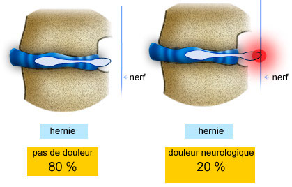 Anomalies anatomiques : Protrusion discale et Hernie discale