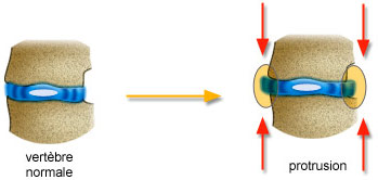 Anomalies anatomiques : Protrusion discale et Hernie discale