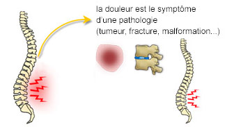 Nature lombalgie symptomatique