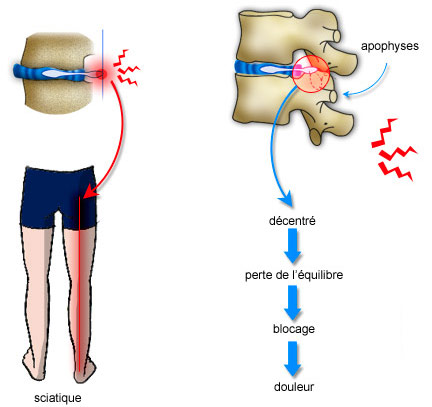 Anomalies anatomiques : Protrusion discale et Hernie discale