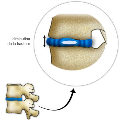 Souplesse disque intervertébral