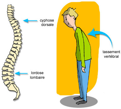 Ceintures lombaires : pathologies concernées